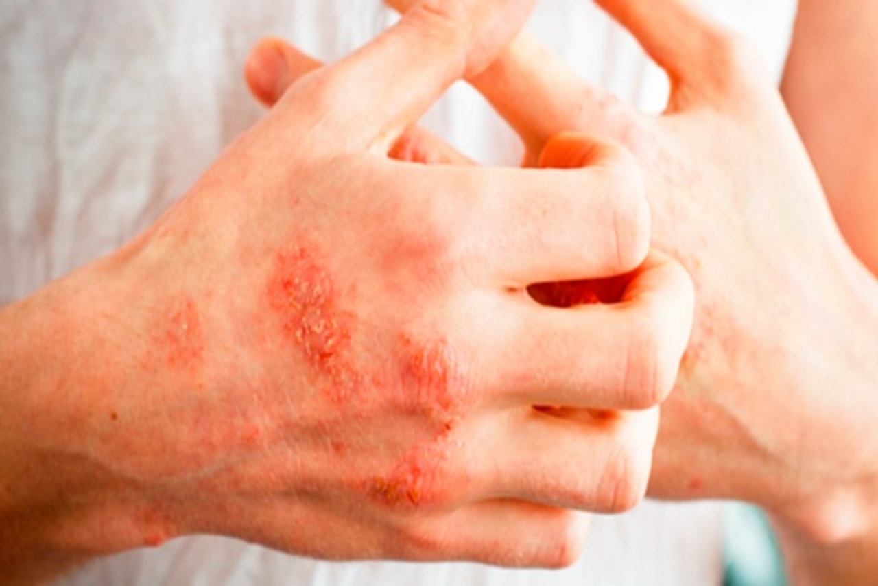 اگزما را بشناسیم