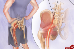 راه های تشخیص سیاتیک و درمان آن