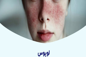 لوپوس چیست؟