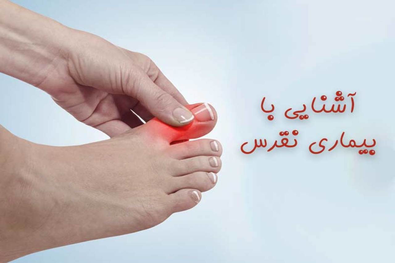 بیماری نقرس چیست؟