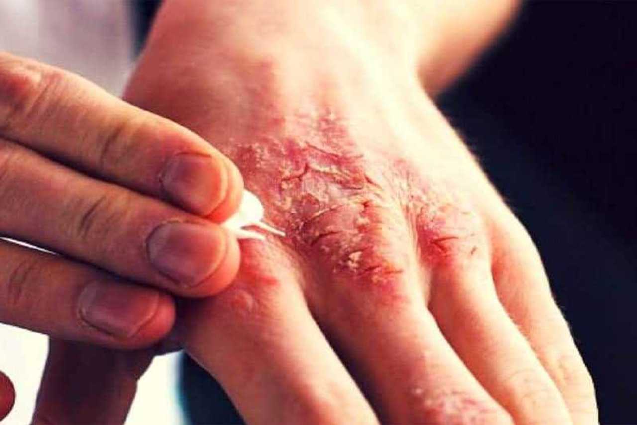 بیماری گال چیست؟