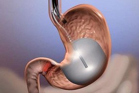 جراحی کاهش وزن باعث افزایش طول عمر می شود