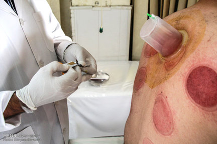 حجامت در چه صورت مفید است/ ماجرای حجامت حزیران