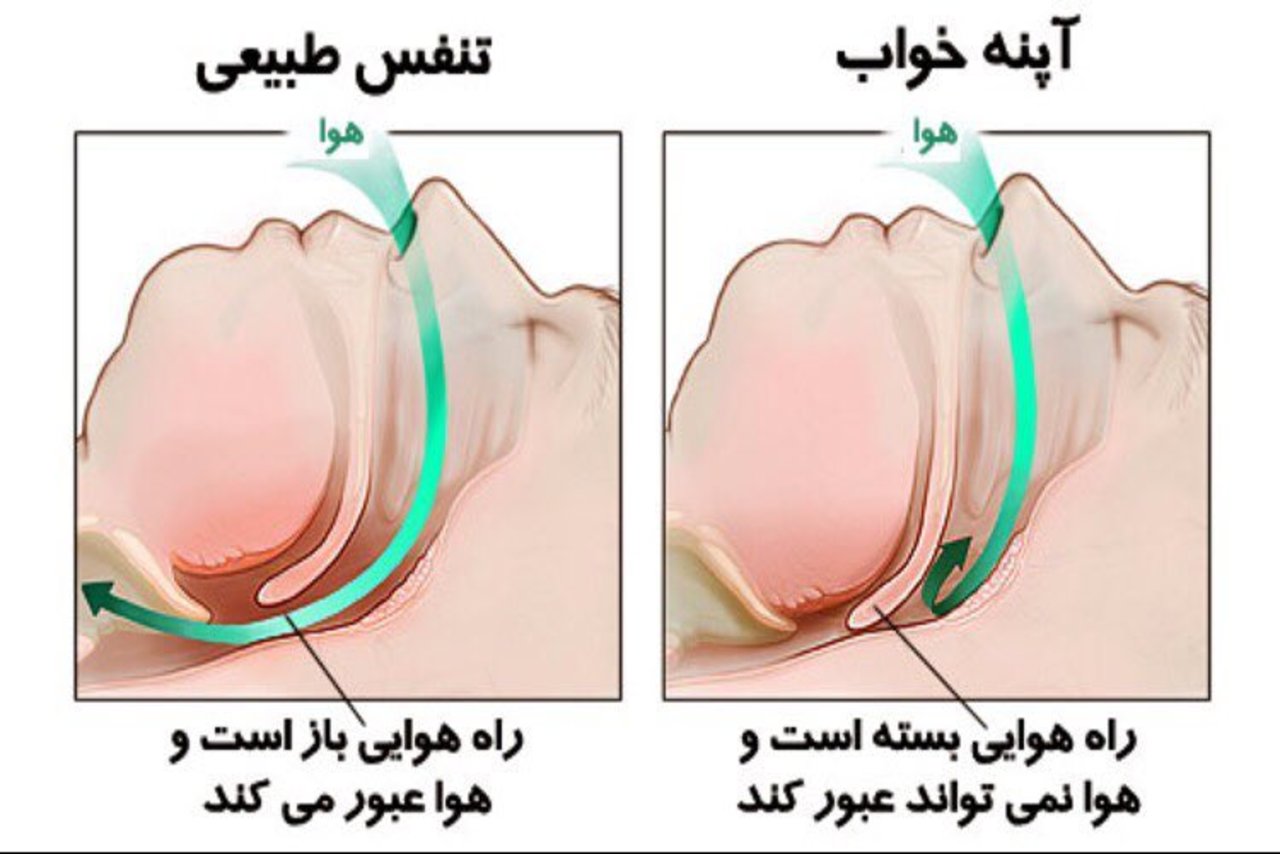 آپنه خواب با کاهش اکسیژن خون، خطرات قلبی را افزایش می دهد