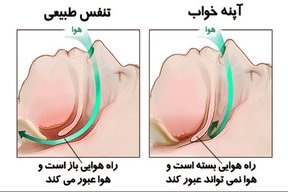 آپنه خواب با کاهش اکسیژن خون، خطرات قلبی را افزایش می دهد