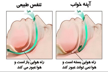 آپنه خواب با کاهش اکسیژن خون، خطرات قلبی را افزایش می دهد